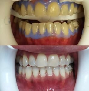 blanchiment dentaire à agadir