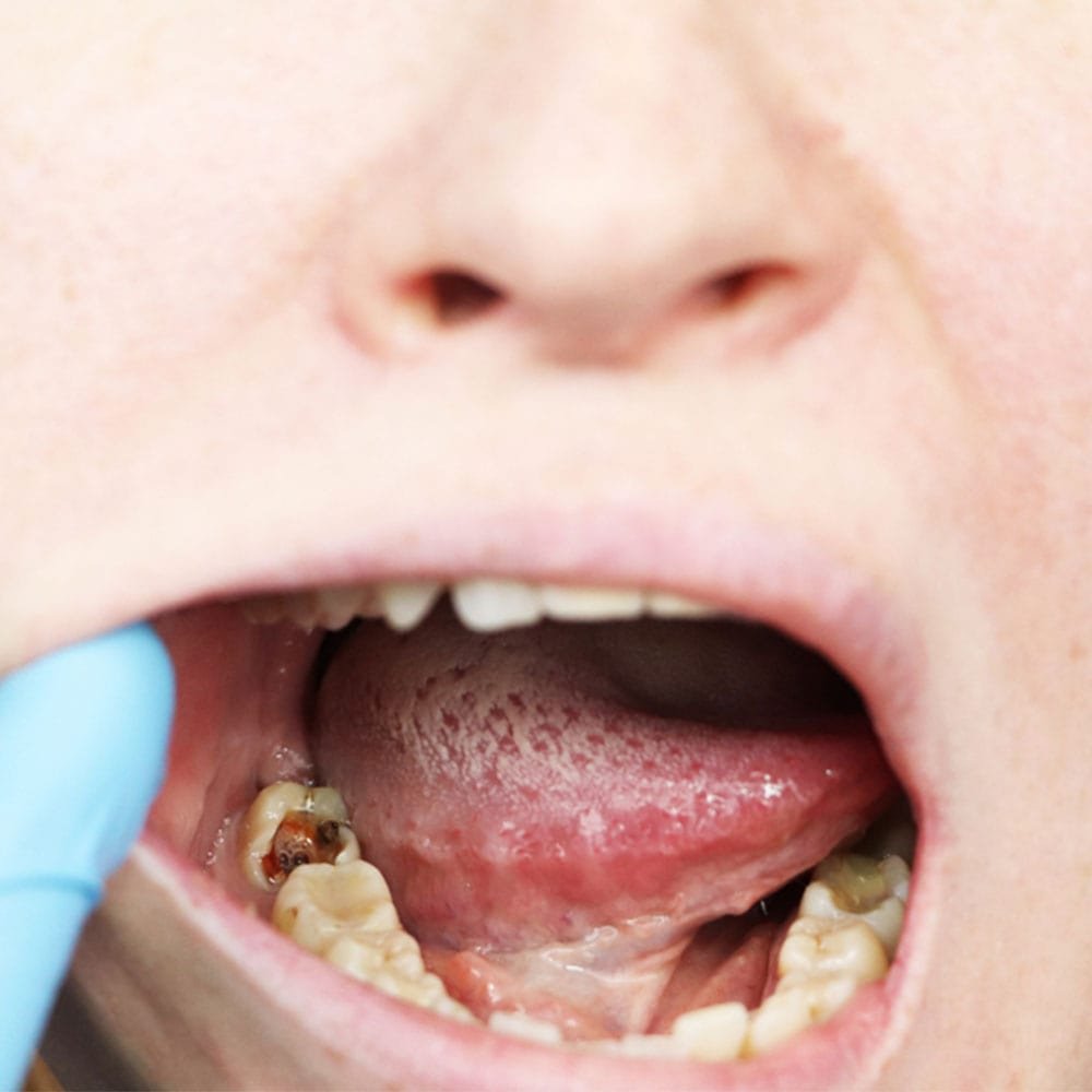 traitement canalaire