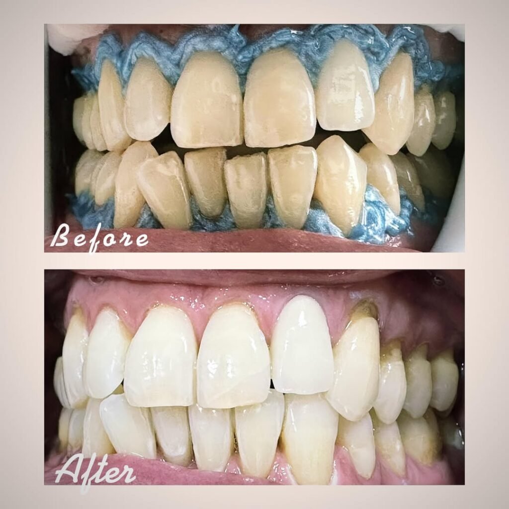 blanchiment dentaire agadir