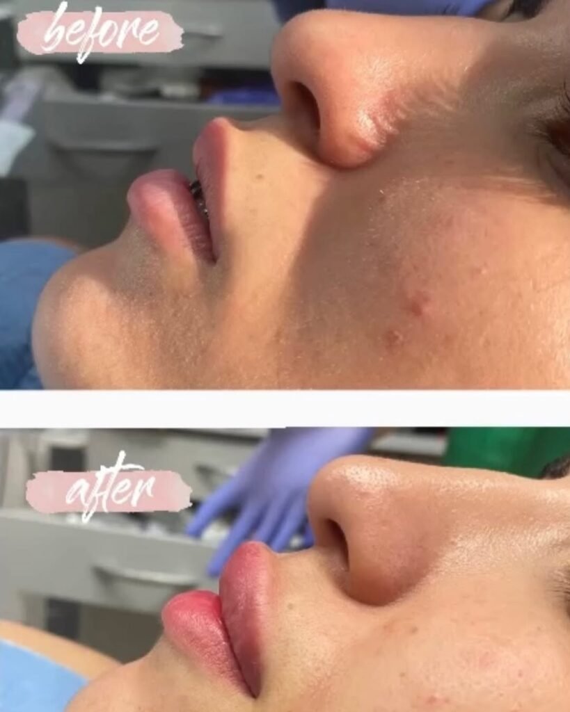 lip fillers agadir
